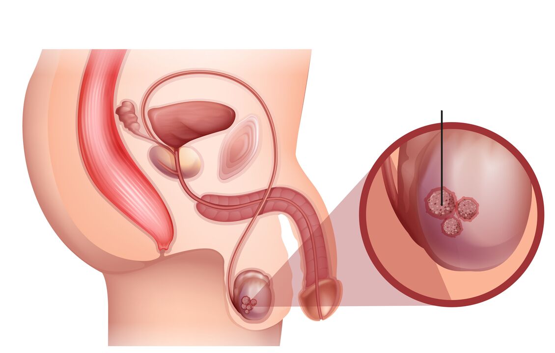 příznaky rakoviny prostaty